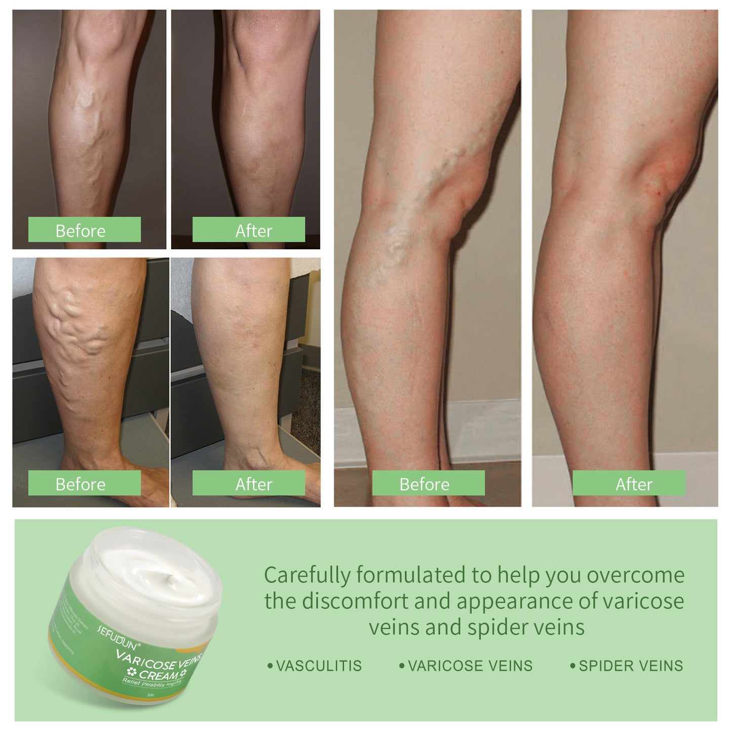 Varicose Vein Cream - Safflower Relief for Spider Veins & Leg Bruises