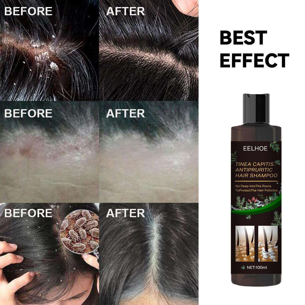 EELHOE Anti-Dandruff Shampoo - Itch Relief & Hair Loss Prevention | Oil Control Formula