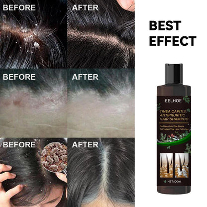 EELHOE Anti-Dandruff Shampoo - Itch Relief & Hair Loss Prevention | Oil Control Formula